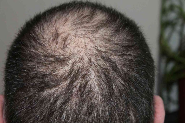 Haarausfall bei Männern und Frauen - mediclife.de