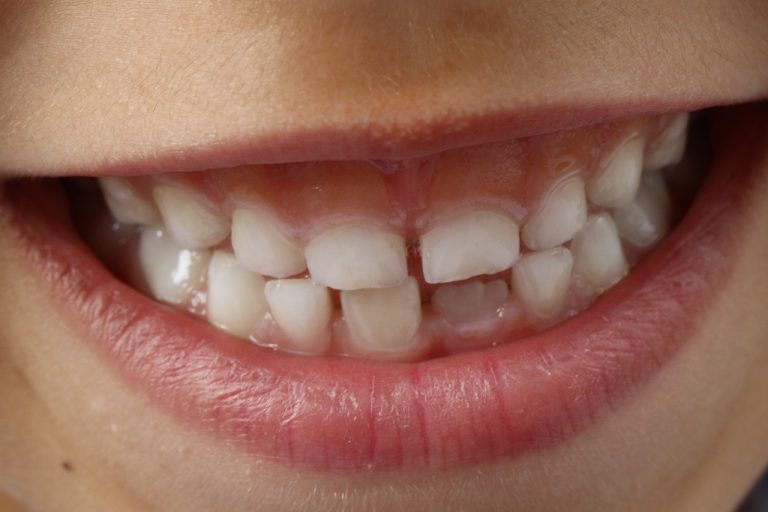 Zahnpflege bei Kindern: Fluoridmengen nach Alter 1 Zahnpflege bei Kindern: Fluoridmengen nach Alter - mediclife.de