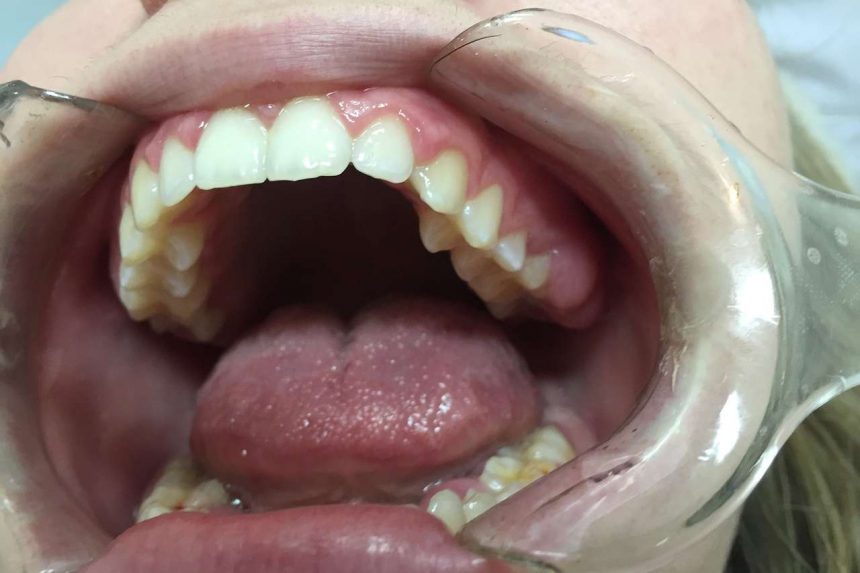 Zahnregulierung in fast jedem Alter möglich